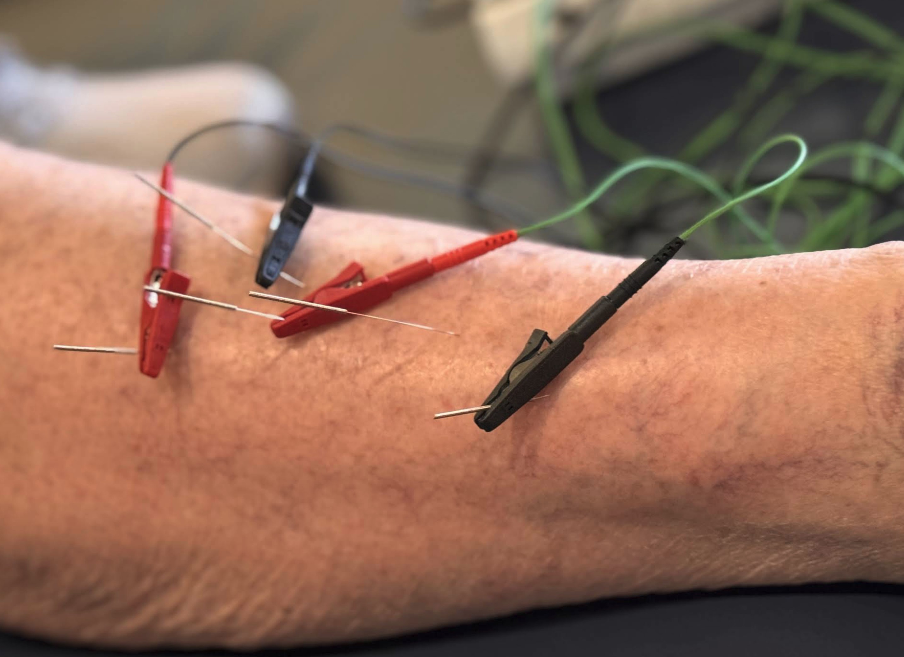 Dry needling with electrical stimulation at South Jersey Physical Therapy